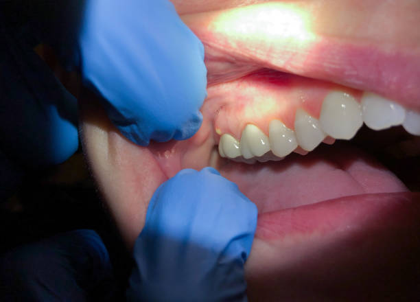 Best Emergency Tooth Extraction in Harrisonburg, VA
